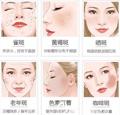 常見臉部皮膚色斑問題