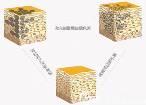 超皮秒解決面部色素原理