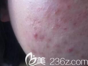 光子嫩膚和微針哪個祛痘印痘坑效果好？