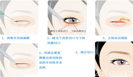 外切去眼袋手術(shù)過(guò)程