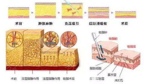 腰腹吸脂手術(shù)流程
