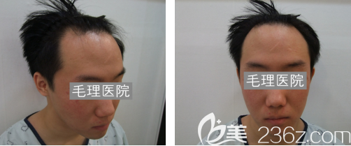 韓國毛理醫(yī)院發(fā)際線種植真人案例 韓國毛理醫(yī)院發(fā)際線種植真人案例