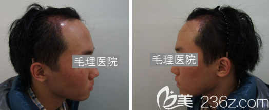 韓國毛理醫(yī)院植發(fā)術后15天恢復效果 韓國毛理醫(yī)院植發(fā)術后15天恢復效果