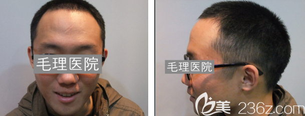 韓國植發(fā)際線多少錢？韓國毛理醫(yī)院發(fā)際線種植價格優(yōu)惠，看下小哥哥植發(fā)術(shù)后6個月恢復(fù)圖