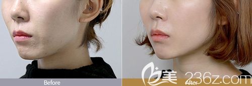 韓國ID激光除皺案例