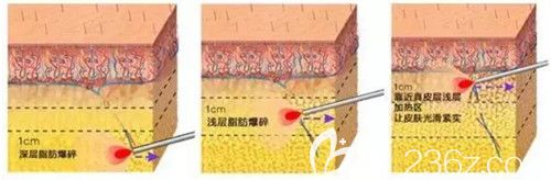 激光溶脂瘦臉手術(shù)過程