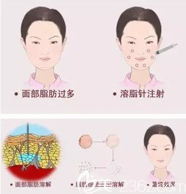 激光溶脂瘦臉效果明顯且恢復(fù)期短