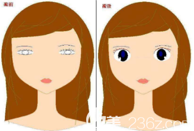 韓式高分子雙眼皮手術(shù) 韓式高分子雙眼皮手術(shù)