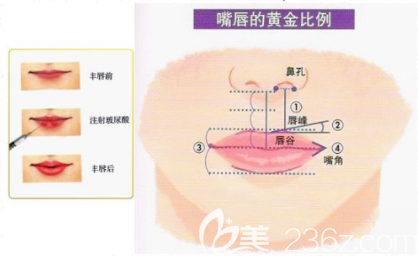 玻尿酸豐唇維持多久呢？