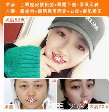 貴陽美貝爾整形特推國慶節(jié)優(yōu)惠福利！膨體隆鼻999元起，另附雙眼皮鼻綜合案例