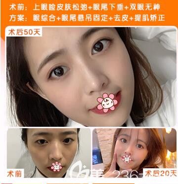 貴陽(yáng)美貝爾上眼瞼提肌