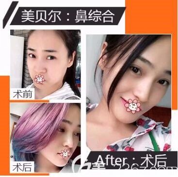 貴陽(yáng)美貝爾隆鼻怎么樣