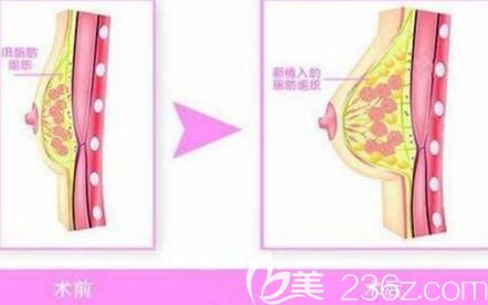 自體脂肪豐胸二次填充術(shù)前術(shù)后對比效果
