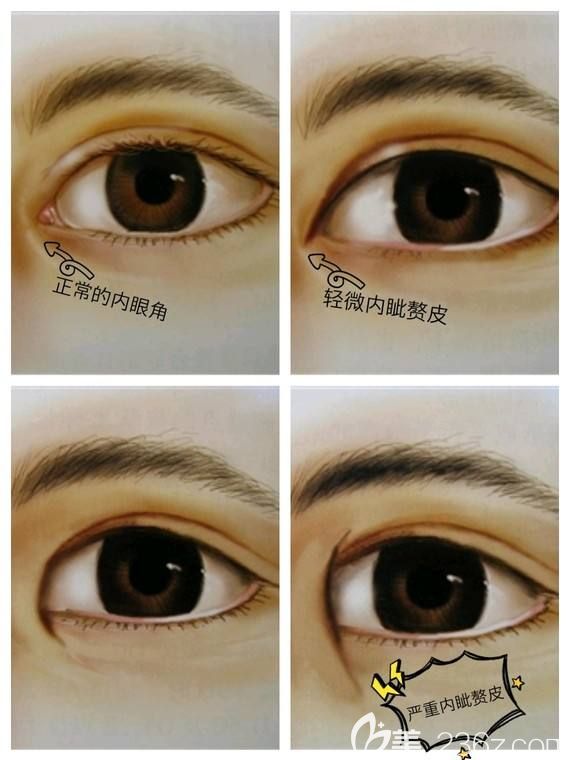 內(nèi)眥贅皮的幾種情況分類