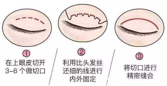 上海愉悅美聯(lián)臣醫(yī)療美容醫(yī)院陳紅梅切開雙眼皮 上海愉悅美聯(lián)臣醫(yī)療美容醫(yī)院陳紅梅切開雙眼皮