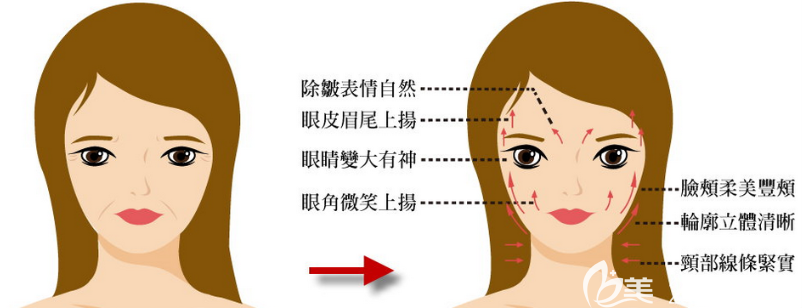 上海美聯(lián)臣整形醫(yī)院艷面部除皺