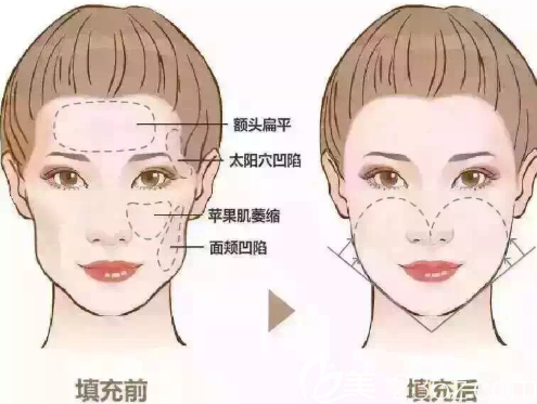 上海愉悅美聯(lián)臣醫(yī)療美容醫(yī)院孫豪成自體脂肪面部填充 上海愉悅美聯(lián)臣醫(yī)療美容醫(yī)院孫豪成自體脂肪面部填充