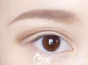 做完全切雙眼皮后的緊繃感多久會(huì)消失？