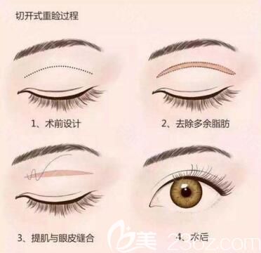 全切雙眼皮手術(shù)過程示意圖