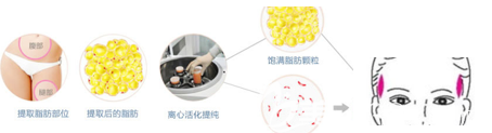 自體脂肪豐太陽(yáng)穴手術(shù)過(guò)程圖