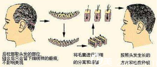上海愉悅美聯(lián)臣醫(yī)療美容醫(yī)院孫永剛毛發(fā)種植 上海愉悅美聯(lián)臣醫(yī)療美容醫(yī)院孫永剛毛發(fā)種植