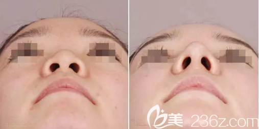 鼻頭縮小案例展示 鼻頭縮小案例展示