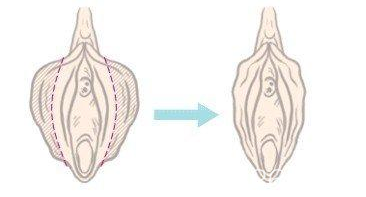 小陰唇肥大修復(fù)后的樣子