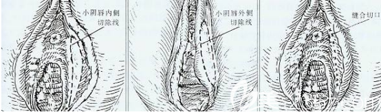 小陰唇肥大手術(shù)示意圖