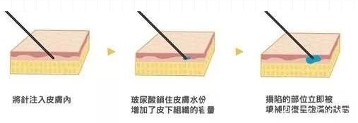 玻尿酸注射圖解