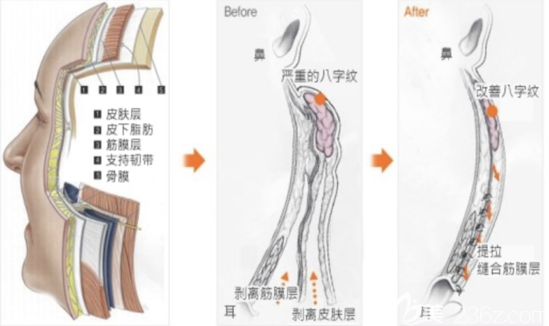 縱深肌理歸位術(shù)提升效果模擬圖