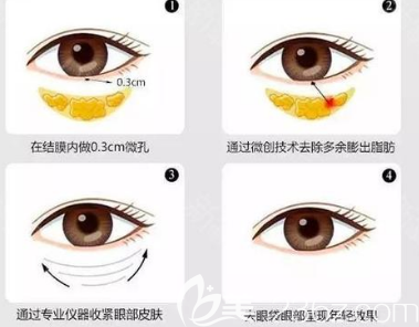 淚溝填充手術(shù)示意圖 淚溝填充手術(shù)示意圖