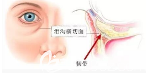 淚溝的樣子 淚溝的樣子