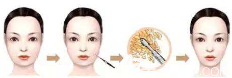 面部吸脂對比照