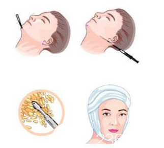 面部吸脂手術示意圖