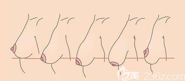 導(dǎo)致胸軟下垂的原因介紹