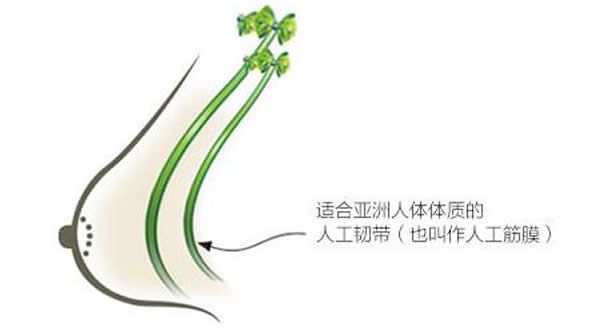 不開(kāi)刀人工韌帶乳房提升術(shù)優(yōu)勢(shì)介紹