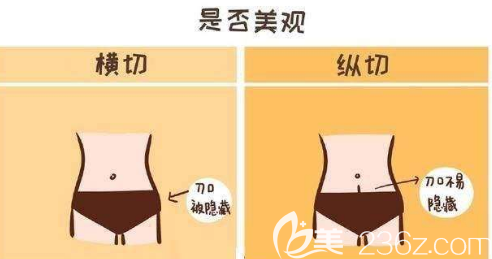 生孩子后肚子的疤痕