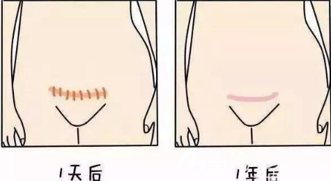 剖腹產(chǎn)的圖片