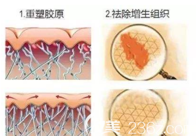 激光祛除瘢痕的示意圖