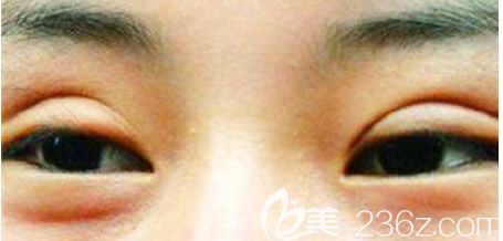 埋線雙眼皮不對(duì)稱 埋線雙眼皮不對(duì)稱
