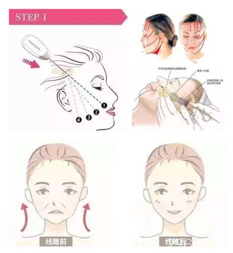 尹延喜醫(yī)生做面部線雕提升手術過程 尹延喜醫(yī)生做面部線雕提升手術過程