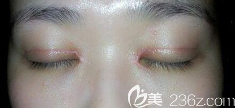 雙眼皮術后護理不當造成雙眼皮疤痕增生