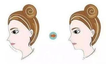 假體墊下巴前后效果展示