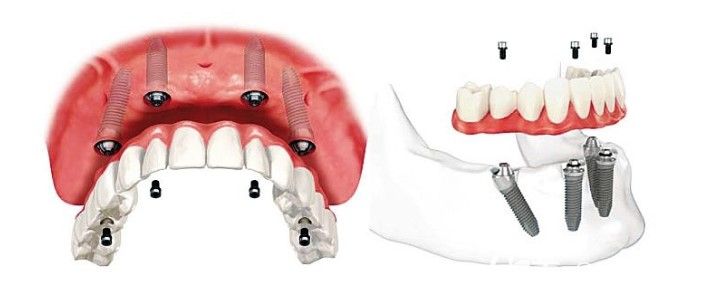 特色技術(shù)one-day-apple種植牙技術(shù)