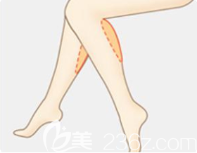 小腿吸脂后可以走路嗎？韓國(guó)365mc吸脂醫(yī)院李善鎬來(lái)解答