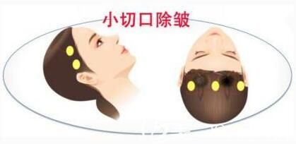 小切口面部提升術可以維持多久呢？