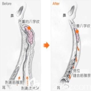韓國清潭first整形外科小切口提升術效果展示