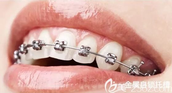 想在杭州做牙齒整形?不妨來(lái)維樂(lè)口腔了解下,而且金屬托槽牙齒矯正價(jià)格才9800元起