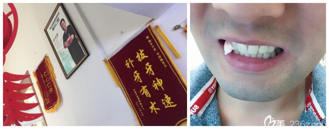 洛陽(yáng)維樂(lè)口腔鄧醫(yī)生拔智齒后評(píng)價(jià) 洛陽(yáng)維樂(lè)口腔鄧醫(yī)生拔智齒后評(píng)價(jià)