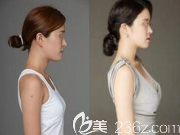 美可整形醫(yī)院假體隆胸真人前后效果對比
